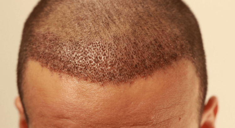 Saç Ektirme Operasyonunun Riskleri Nelerdir?